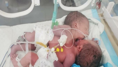 اليمن.. "الصحة العالمية" تكذب الحوثيين حول رفضها نقل توأم سيامي لتلقي العلاج