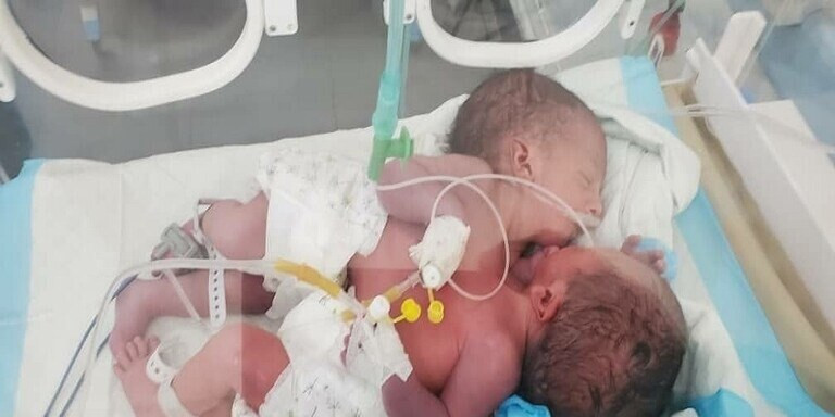 اليمن.. "الصحة العالمية" تكذب الحوثيين حول رفضها نقل توأم سيامي لتلقي العلاج