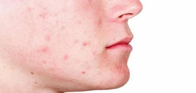 تفسير حلم الحبوب في الوجه: دلالات الجمال والتحديات